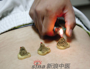 灸法的種類  你知道多少？